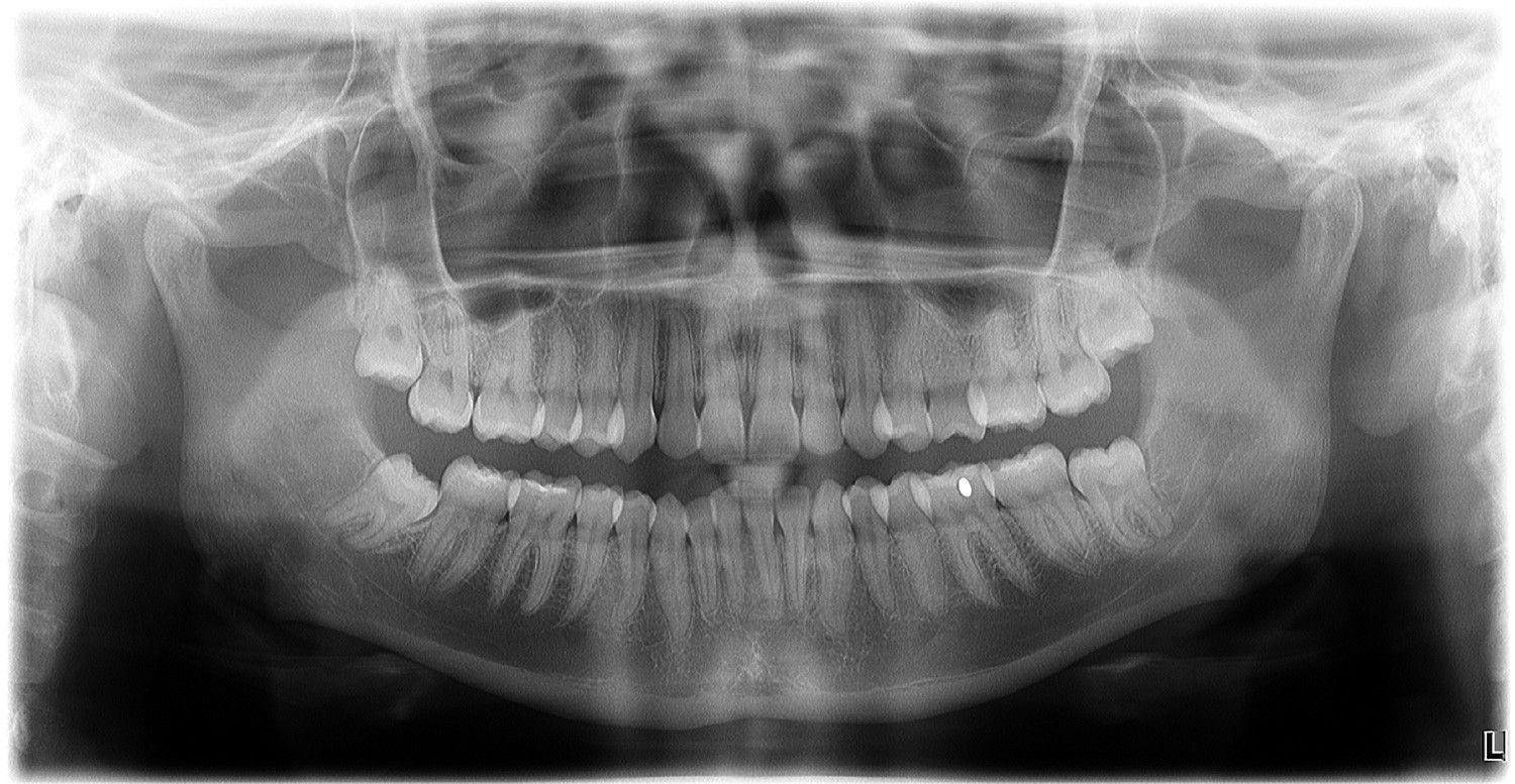 exposure to x ray