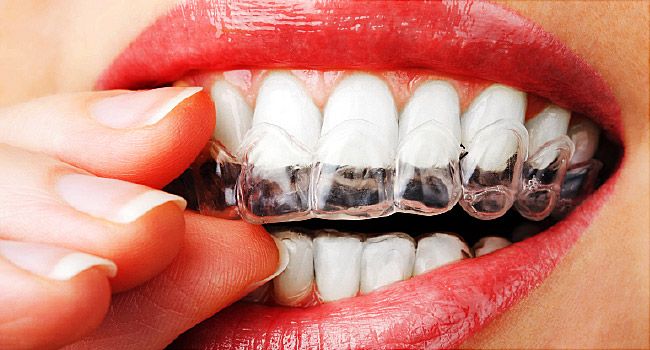 Teeth Whitening 101 | Teeth Whitening Geneva IL